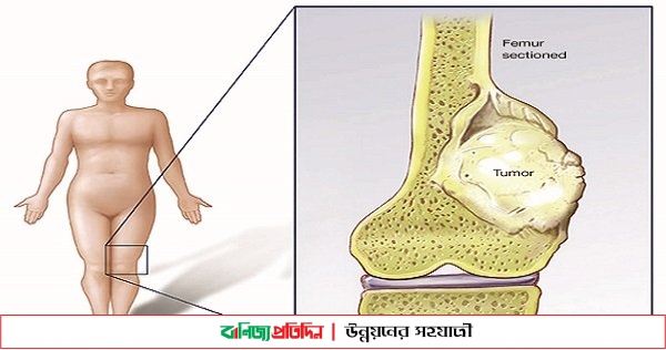 মরণব্যাধি বোন ক্যান্সার