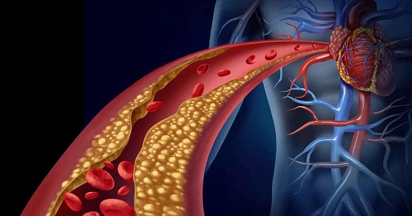 হাই কোলেস্টেরল যে ৫ প্রাণঘাতী রোগের কারণ